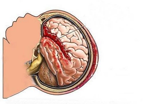 
Chảy máu não thất thường do nguyên phát hoặc thứ phát, trong một số trường hợp, chảy máu não thất có thể không xác định chính xác nguyên nhân
