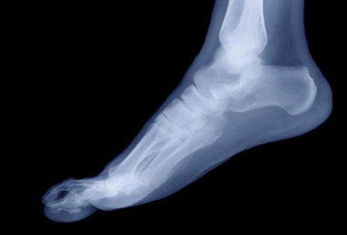 X-ray procedure of the straight heel bone