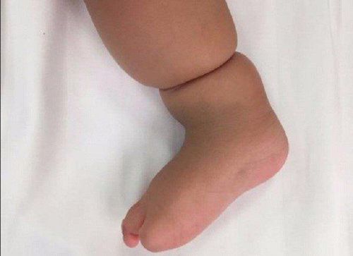 
Extremity in children with amniotic band syndrome
