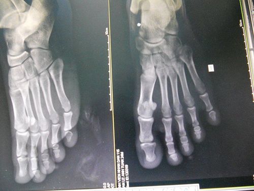 X-ray procedure of straight foot