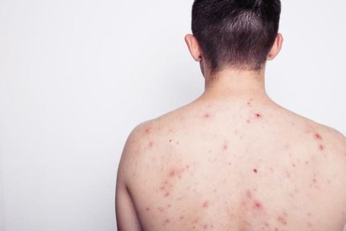 What is HIV Rash? Symptoms of HIV Rash