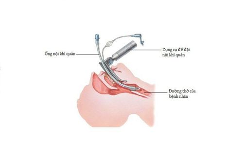 
Trong trường hợp đặt nội khí quản khó cần sử dụng ống nội khí quản có đường kính nhỏ hơn
