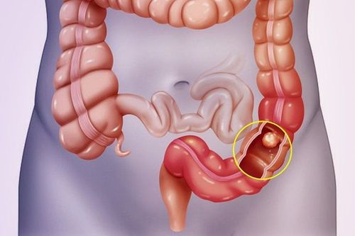 Efficacy of thiopurine monotherapy in ulcerative colitis