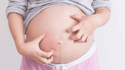 Is it okay to itch a lot during pregnancy?