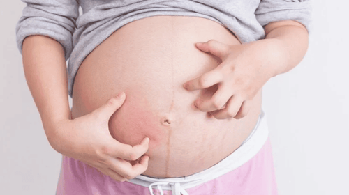 Mắc viêm da cơ địa khi mang thai 29 tuần có sao không?