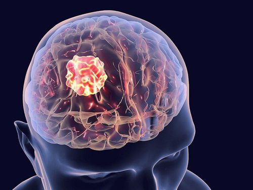 Computed tomography of the brain without contrast for the diagnosis of intra-axial brain tumors