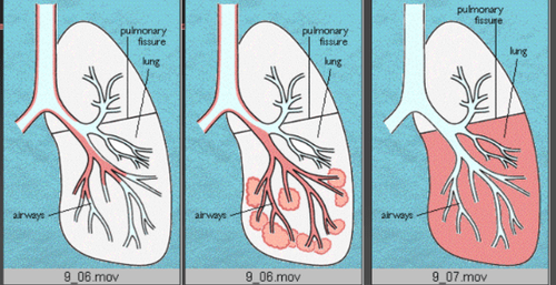 Bệnh phổi kẽ: Những điều cần biết