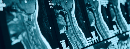 Magnetic resonance imaging procedure of the cervical spine with injection of magnetic contrast agent