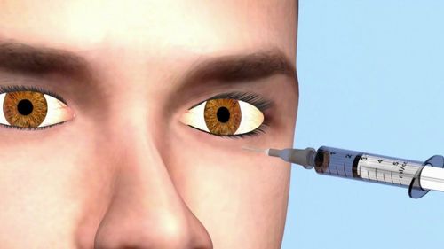 Anesthesia near the eyeball for retinal detachment surgery