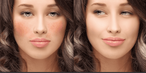 Tăng sắc tố da có thể phòng tránh?