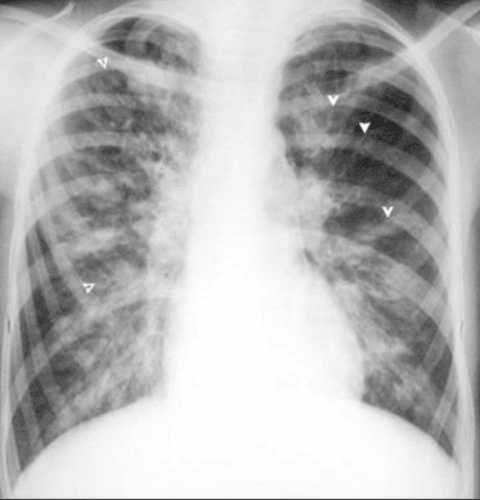 Bronchiectasis on x-ray