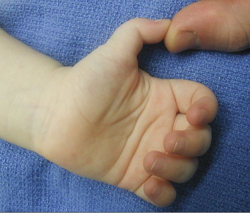 Bé 3 tuổi không duỗi thẳng ngón tay cái được nên xử lý thế nào?