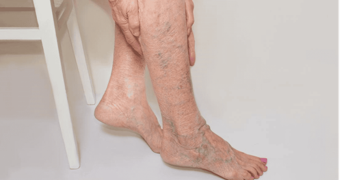 Exercises to treat patients with venous insufficiency of the legs