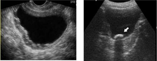 Cystitis image on ultrasound