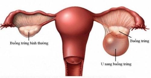 
U nang buồng trứng gồm hai loại: u nang cơ năng lành tính và u nang thực thể
