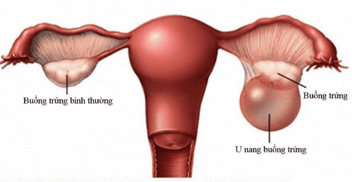 
Hình ảnh khối u nang buồng trứng ở nữ giới
