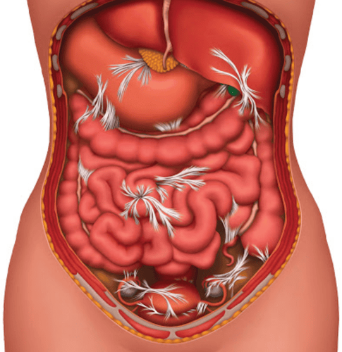 Procedure for endotracheal anesthesia for appendicitis peritonitis surgery