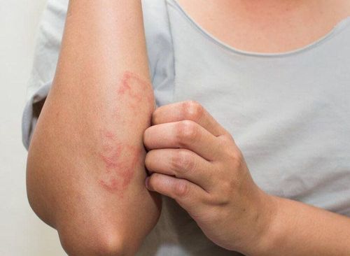 Gibert's pityriasis rosea: Clinical signs and treatment diagnosis