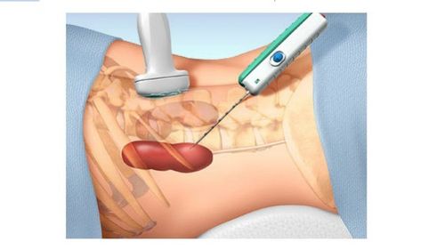 Aspiration of renal cyst fluid under ultrasound guidance