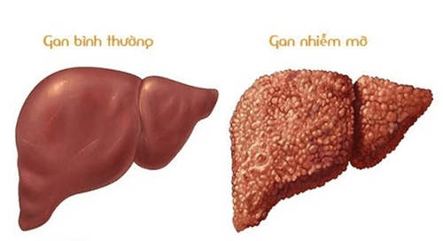 
Gan nhiễm mỡ có thể gây ra nhiều biến chứng nguy hiểm
