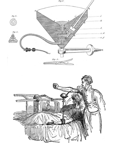 
Hình 1: Các công cụ truyền máu của James Blundell
