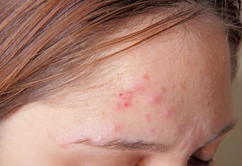 Care for acne-prone skin