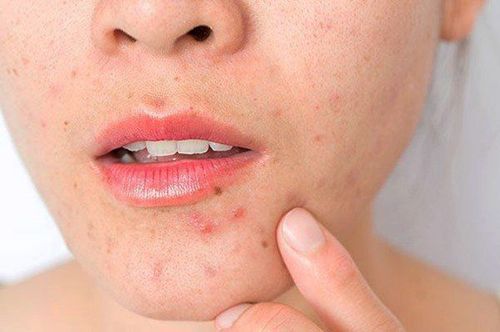 Does drinking alcohol cause acne?