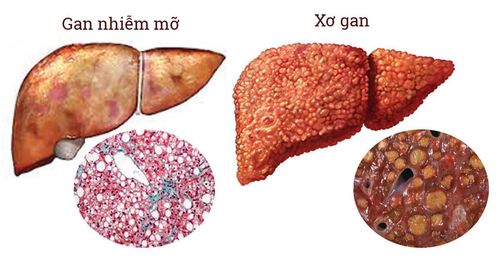 Can fatty liver S4, cirrhosis F2-F3 be cured?