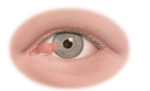 Anesthesia mask larynx conjunctival tumor surgery