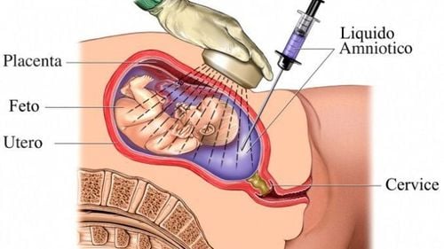 
Sản phụ nên thực hiện chẩn đoán trước sinh cho thai nhi
