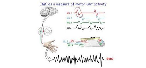 Electrodiagnostic – advantages and disadvantages in the diagnosis of diseases of the peripheral nervous system and muscles