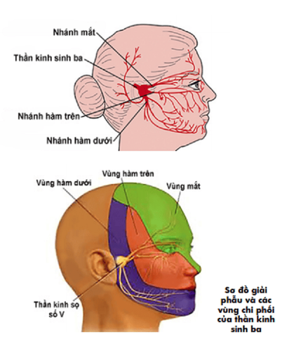 Trigeminal lymphadenectomy (GASSER) by absolute alcohol injection