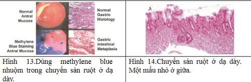 Gastric biopsy diagnoses intestinal metaplasia in the stomach