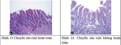 Gastric biopsy diagnoses intestinal metaplasia in the stomach