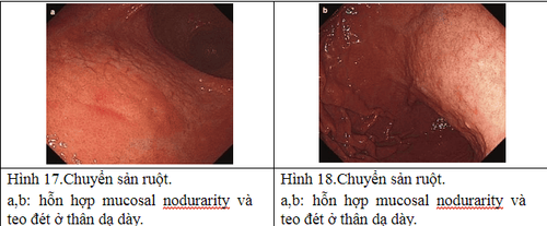 Gastric biopsy diagnoses intestinal metaplasia in the stomach