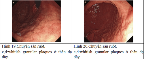 Gastric biopsy diagnoses intestinal metaplasia in the stomach