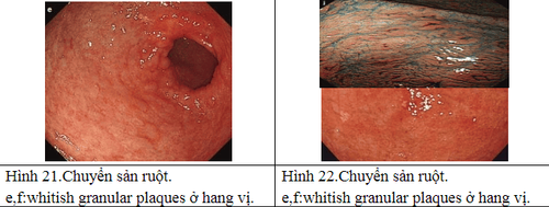 Gastric biopsy diagnoses intestinal metaplasia in the stomach