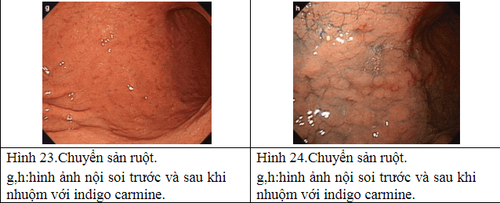 Gastric biopsy diagnoses intestinal metaplasia in the stomach