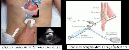 
Các cách thực hiện kỹ thuật chọc hút dịch màng ngoài tim
