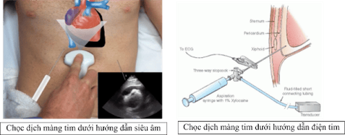 
Các cách thực hiện kỹ thuật chọc hút dịch màng ngoài tim
