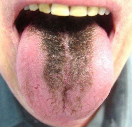 Black hairy tongue: Causes, symptoms