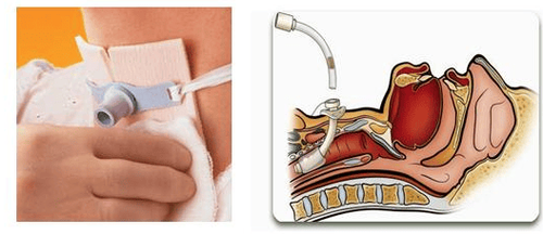 
Mở khí quản được áp dụng đối với bệnh nhân từ khó thở nhẹ đến mức đe dọa ngạt
