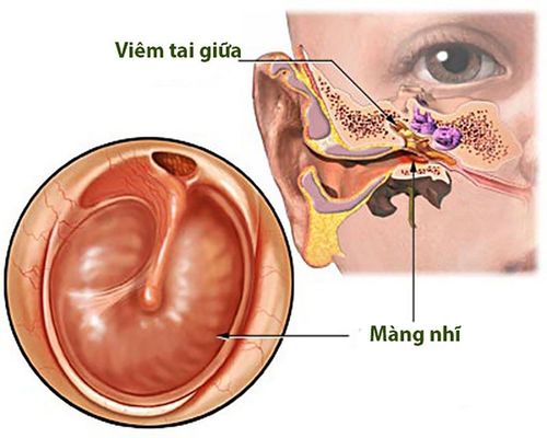 Viêm tai giữa mãn tính do thủng màng nhĩ