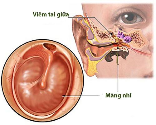 Can otitis media cause perforation of the eardrum?