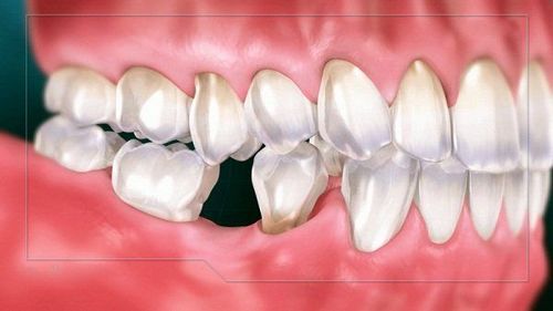 
Cấy ghép Implant All On 6 được chỉ định cho những trường hợp bị mất răng
