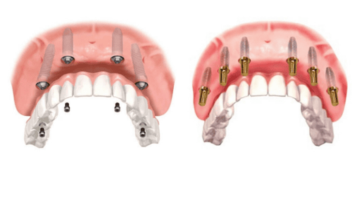 
All on 4 và All on 6 Implant đều có những ưu điểm và nhược điểm khác nhau
