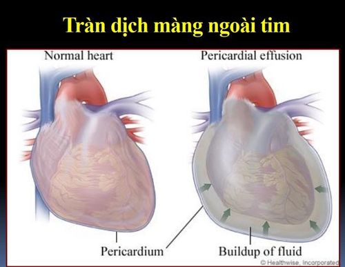 
Bệnh nhân tràn dịch màng ngoài tim không có dấu ép tim được chỉ định chọc dẫn lưu dịch màng ngoài tim qua da
