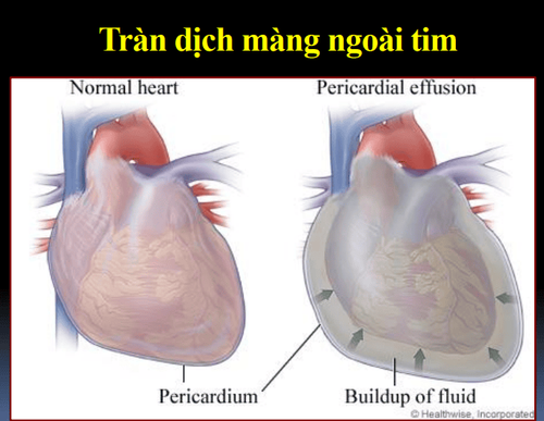 
Tràn dịch màng ngoài tim
