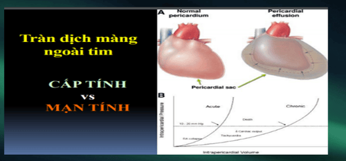 
Tràn dịch màng ngoài tim
