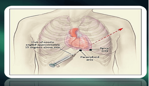 What is acute tamponade? Signs of recognition and treatment